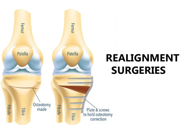 Realignment Surgeries