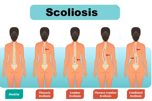 Scoliosis