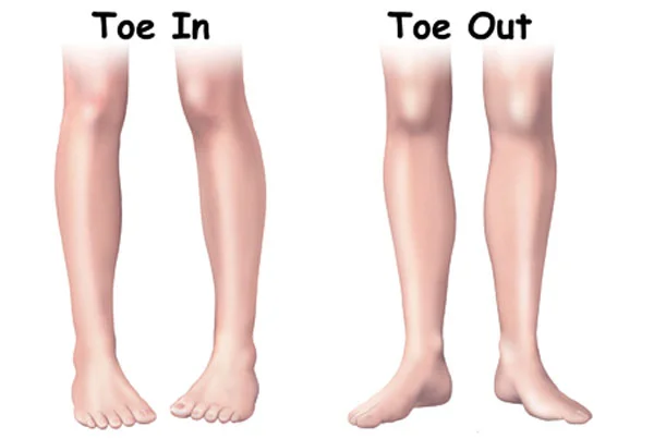 Deformity Correction