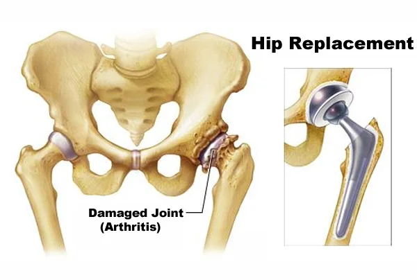 Hip Replacement