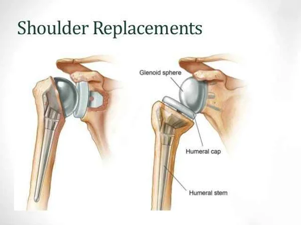 Shoulder Replacement