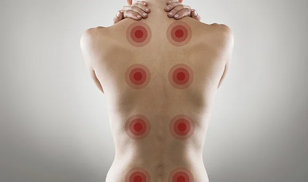 Fibromyalgia