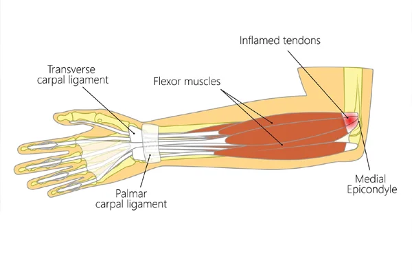 Elbow Pain