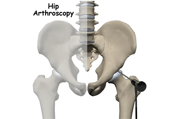 Hip Arthroplasty